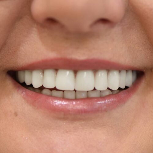 Zęby uzyskane metodą ALL-on-4 w jeden dzień
